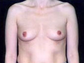 Patient # 50722 Before Photo # 1
